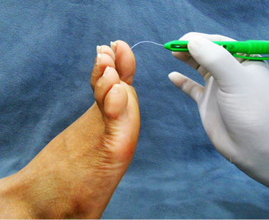 ICD 10 Coding for Diabetic Foot Ulcers