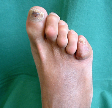 Diabetic Foot Ulcer Treatment in Tumkur| Book A Consultation